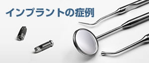 インプラントの症例